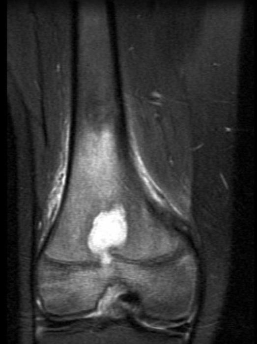 abscess roaming