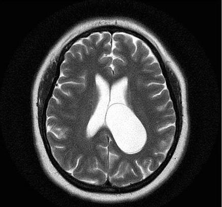 Фото киста головного мозга