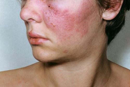 collagen disease