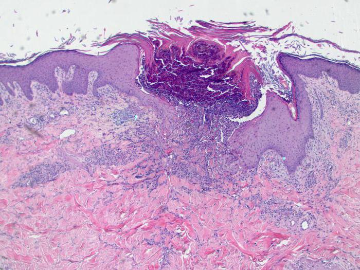 collagenosis what is it