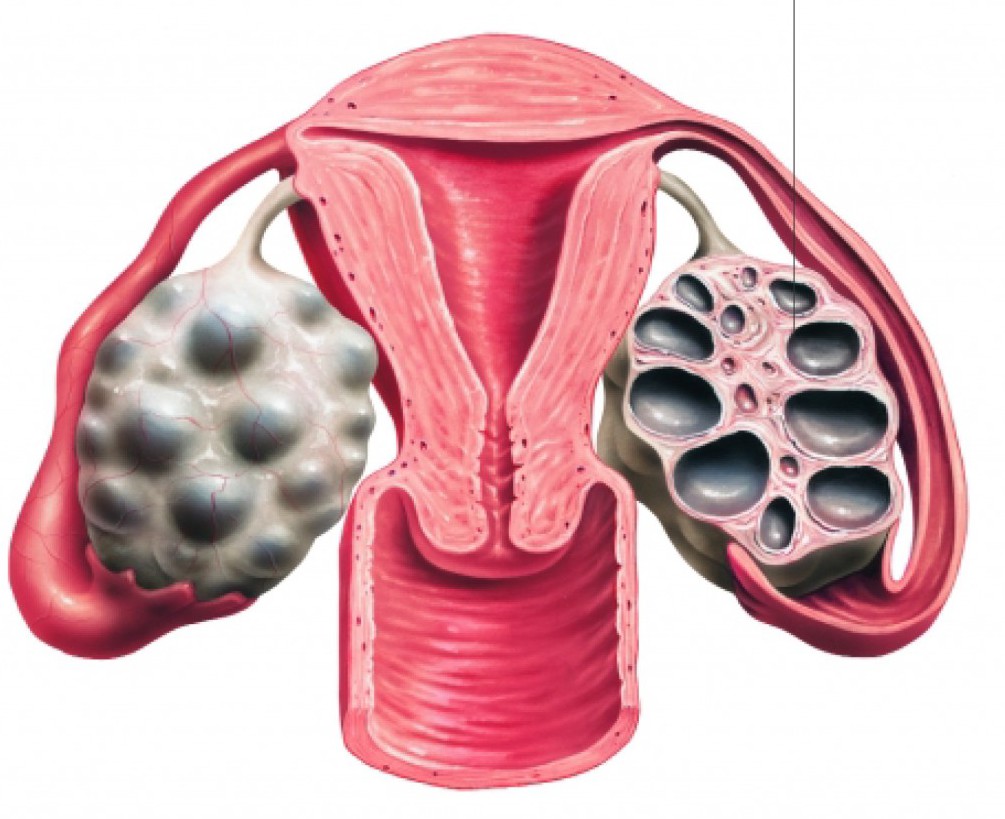 Ovarios poliquísticos y embarazo natural
