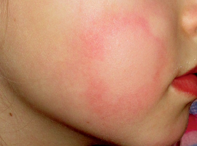 Аллергия на холод у грудничка