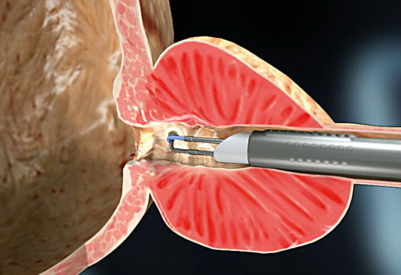 Операция при аденоме простаты