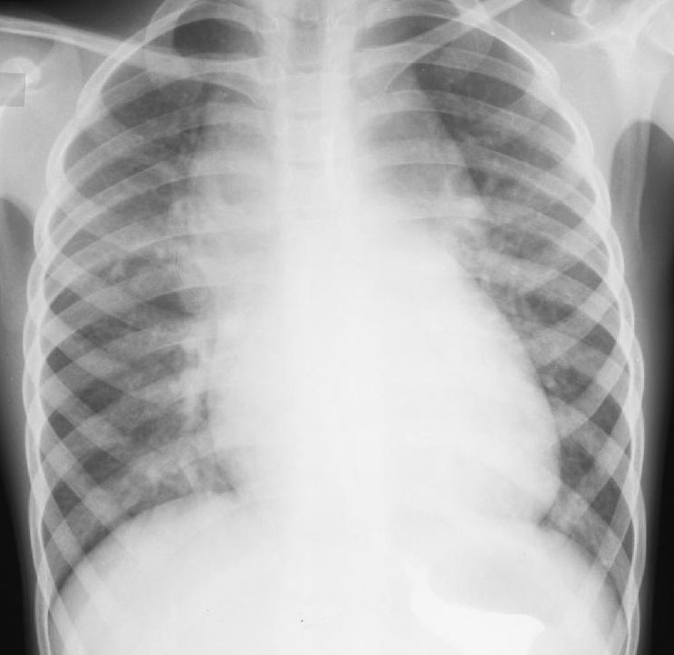 Рентген при легочном сердце