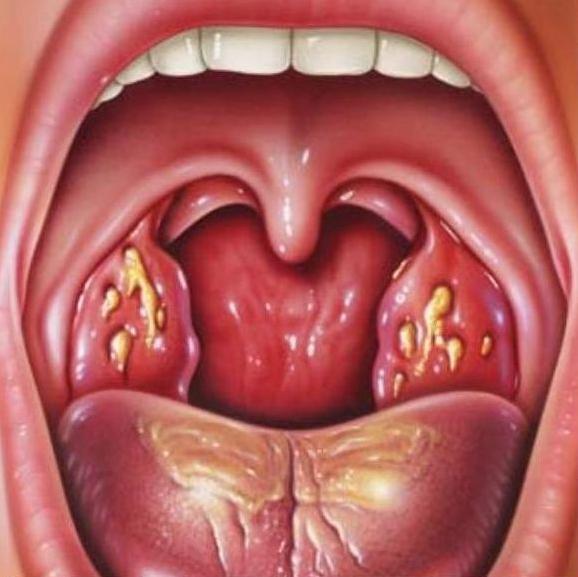 Белые прыщи в горле у ребенка