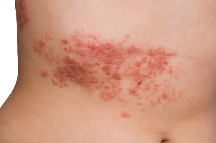 herpetiform dermatitis symptoms