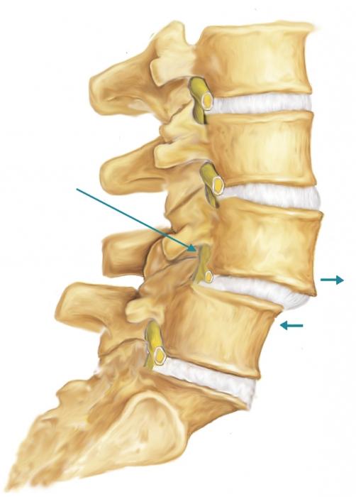 cervical spondylosis