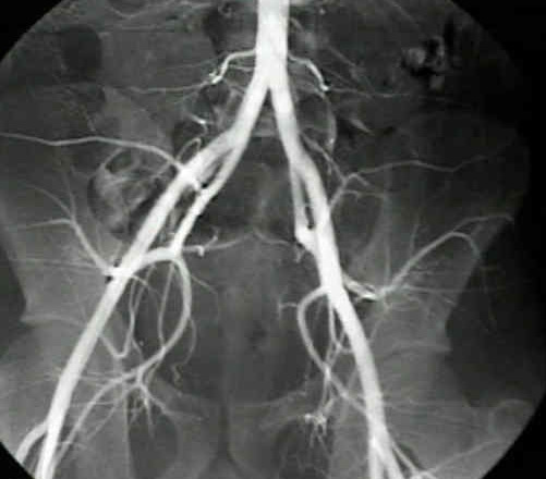 Тромбоз артерий нижних конечностей МКБ-10