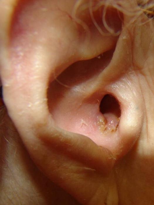 воспаление ушей 