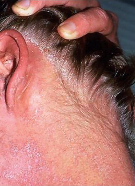 гиперкератоз кожи головы фото 
