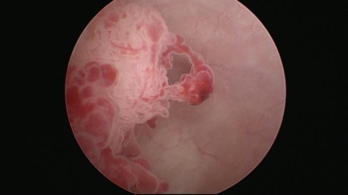 цистоскопия мочевого пузыря фото 