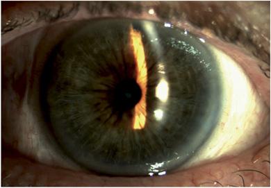 искусственный хрусталик глаза 