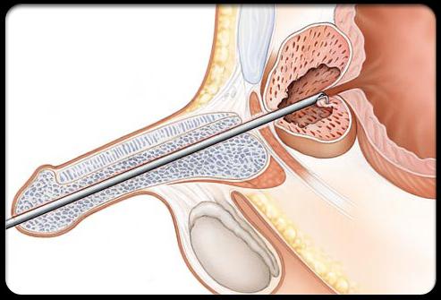 аденома предстательной железы операция 