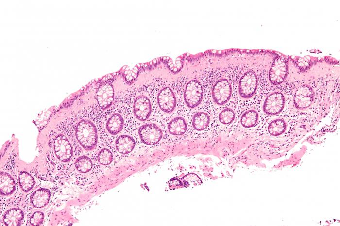 виды колитов и их лечение 