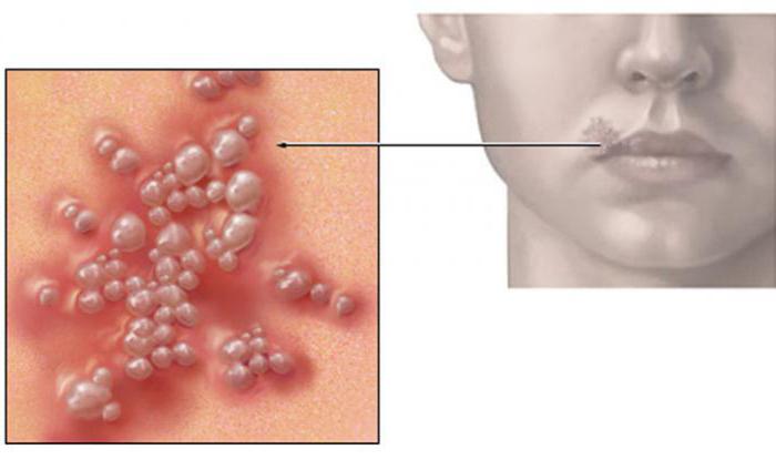 Причины появления герпеса на губах у женщин 11