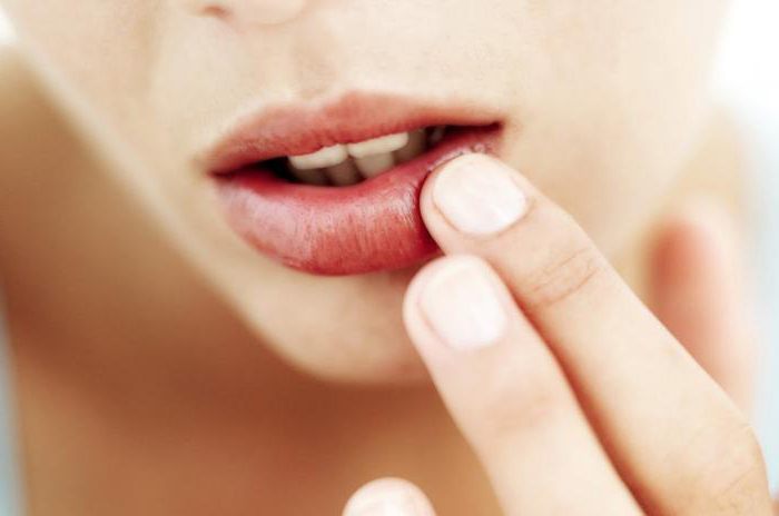 Причины появления герпеса на губах у женщин 13