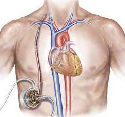 Неотложная помощь при инфаркте миокарда осложненным кардиогенным шоком thumbnail
