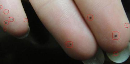 moles on fingers