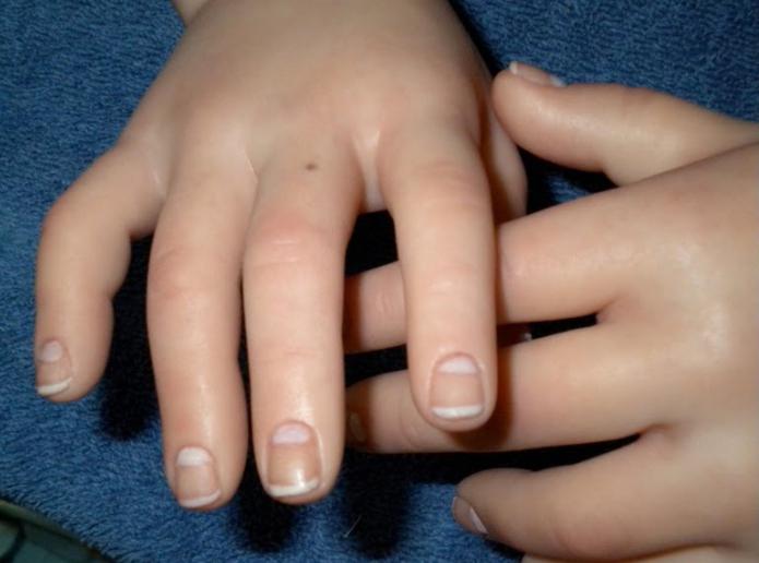 moles on the index finger