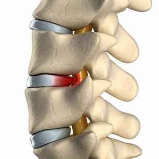 протрузия позвоночника 