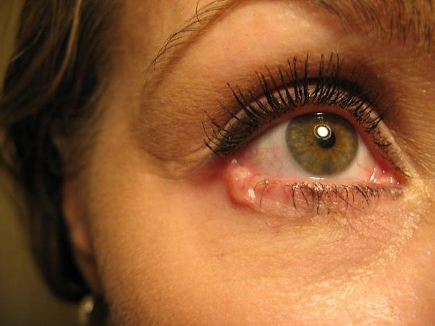 Рак глаза у детей симптомы