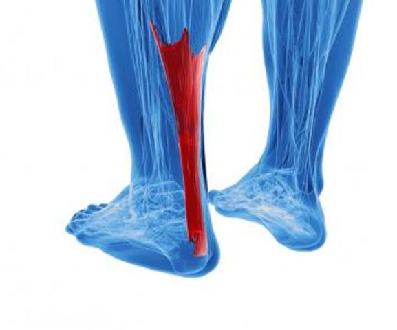 разрыв сухожилия на ноге