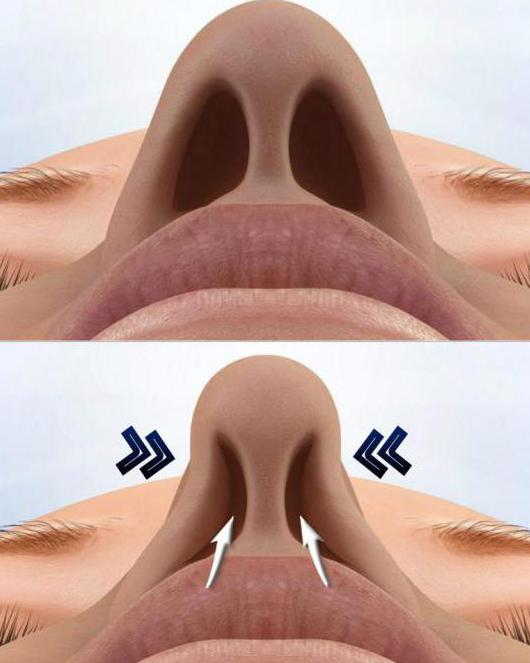перфорация носовой перегородки лечение