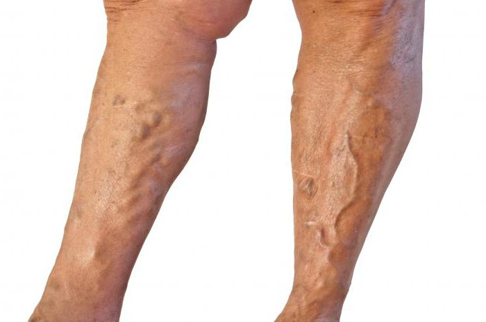 Как вылечить болезнь ног thumbnail