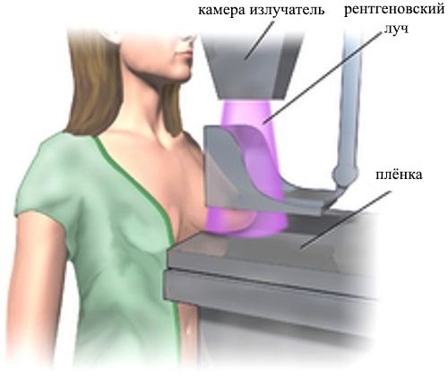 диагностика мастопатии молочной железы