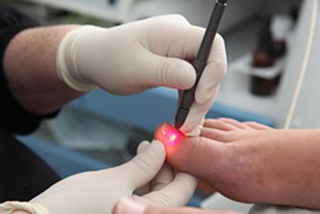 лечение грибка ногтей лазером отзывы