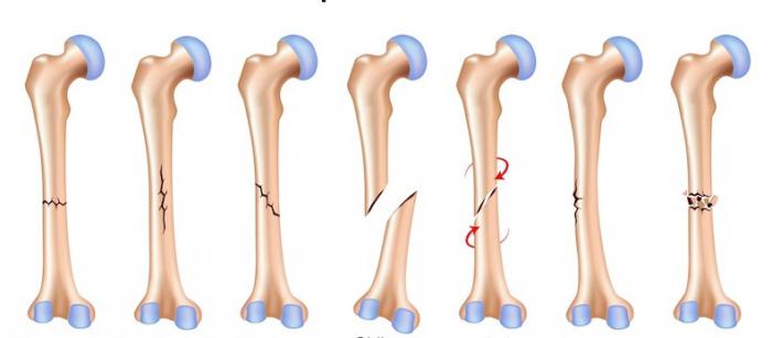 перелом плечевой кости