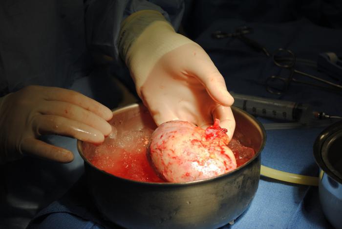 трансплантация органов и тканей