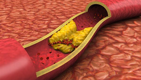 Холестериновые бляшки в сонной артерии