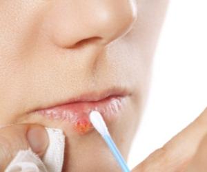 средство против простуды на губах