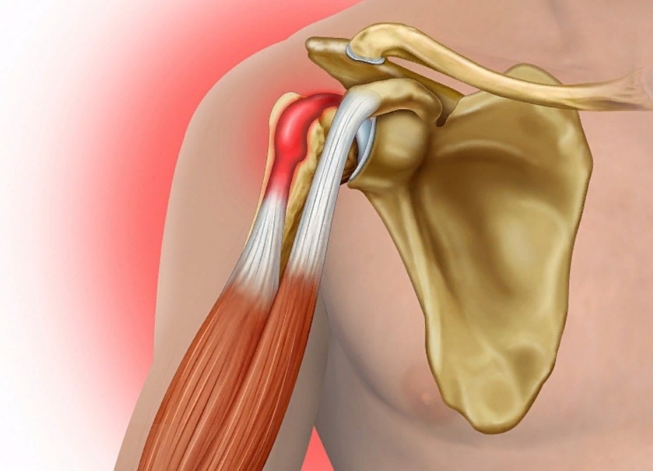 Надрыв сухожилия плечевого сустава лечение