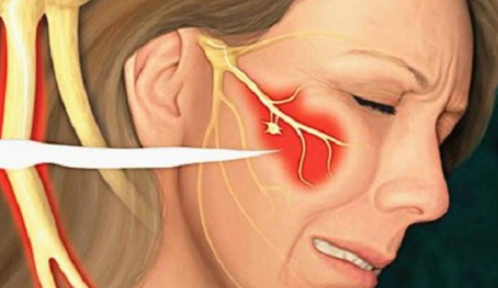 Чем лечить лицевой тройничный нерв