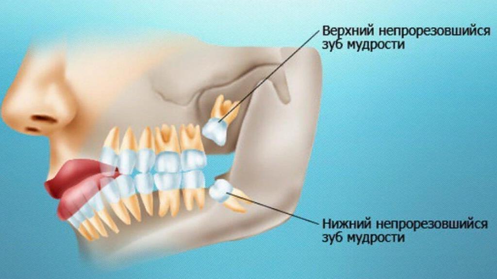 зубы мудрости