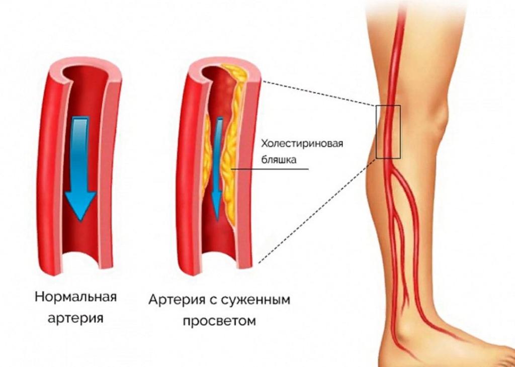 заболевания артерий