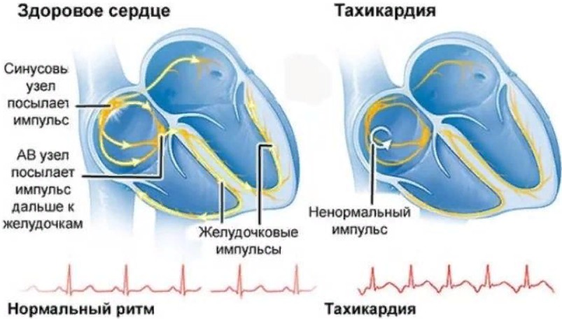 Признаки тахикардия у женщины симптомы. Тахикардия. Тахикардия сердца. Заболевание сердца тахикардия. Усиление сердцебиения.