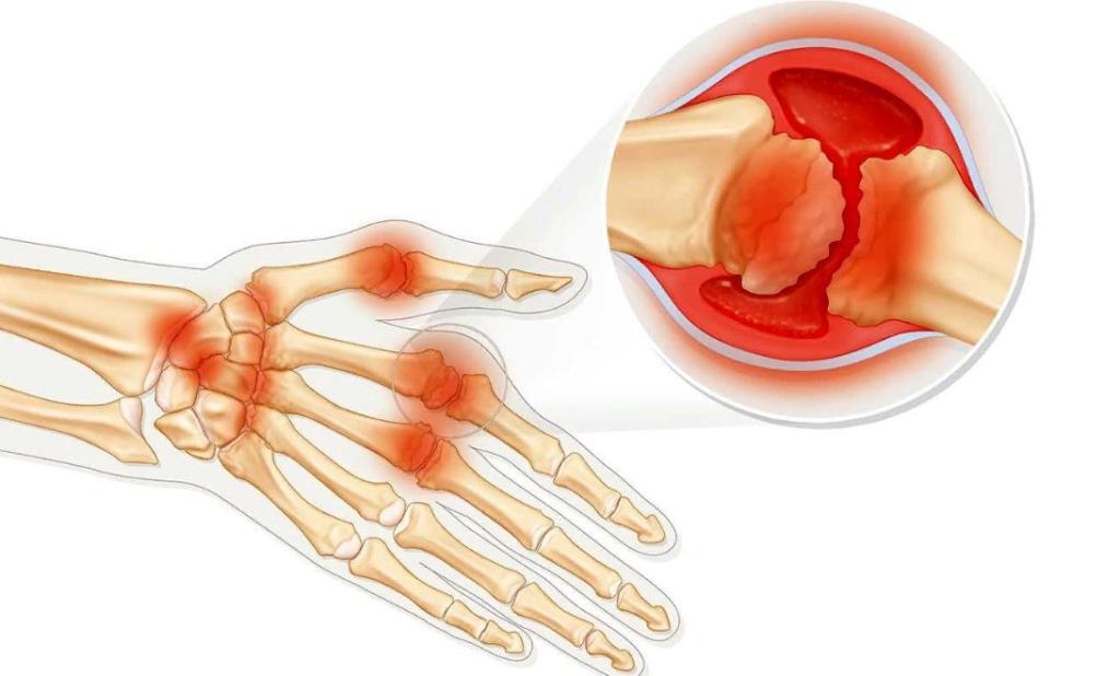 Ревматоидный артрит сустава