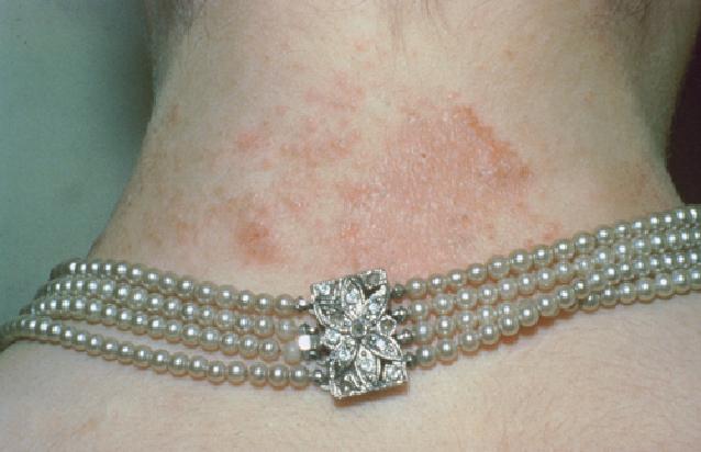Аллергия на железо на ремнях thumbnail