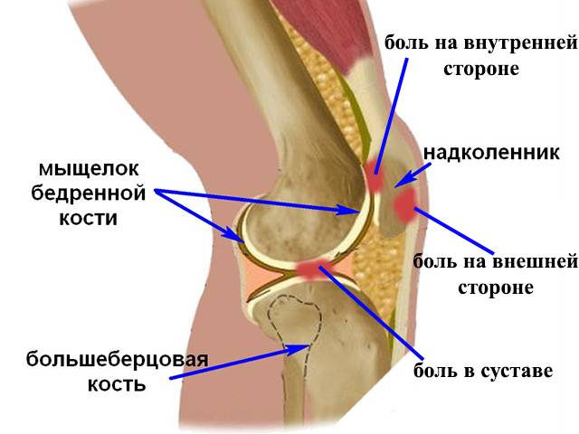 Болят колени причины при приседании