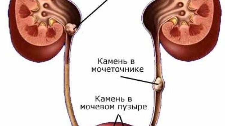 Камни при мочеиспускании как выглядят Как ускорить выход камня из мочеточника: методы, профилактика