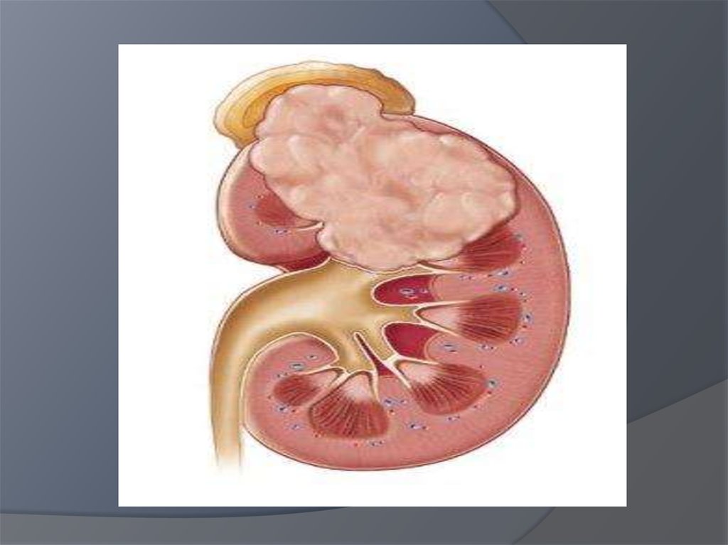 Болезнь лоханки. Нефробластома доброкачественная опухоль. Нефробластома (опухоль Вильмса) препарат. Опухоль почки макропрепарат.
