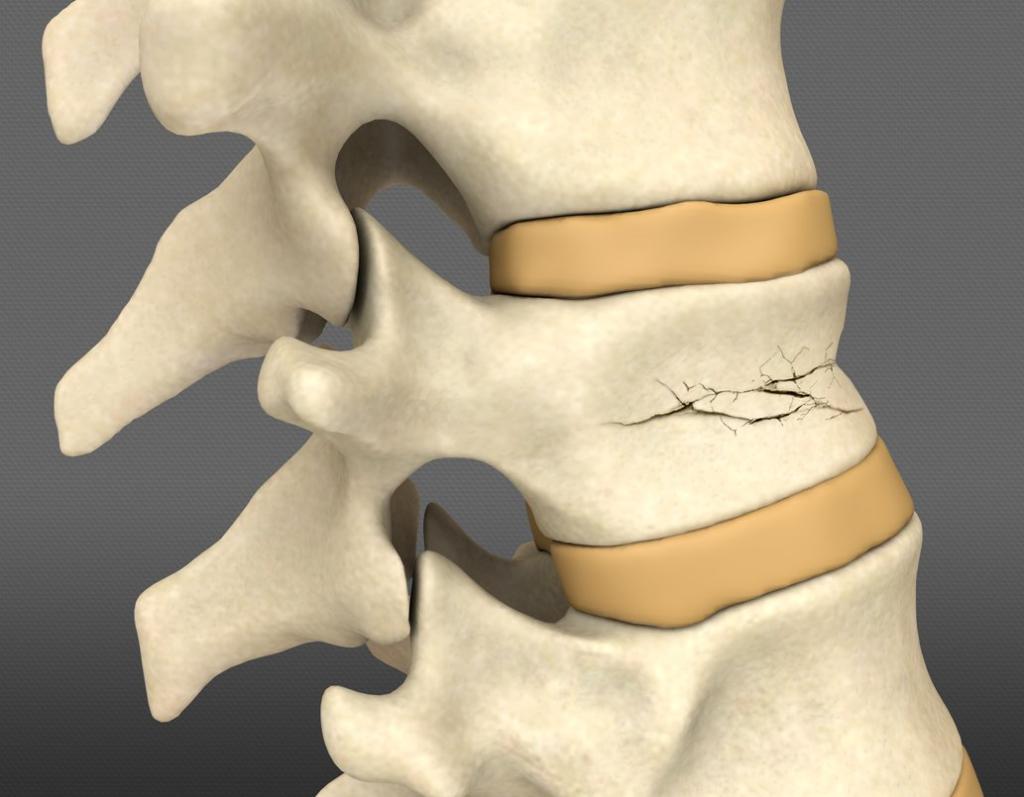 компрессионный перелом позвоночника поясничного отдела 1
