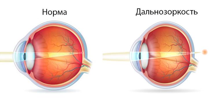 причины дальнозоркости