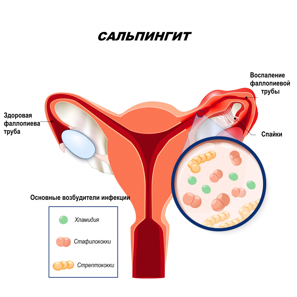 сальпингит это 1