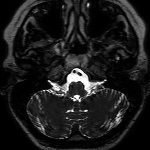 cranial fossa of the inner base of the skull