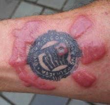 аллергия на татуировку