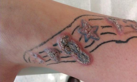 татуировка аллергия на краску